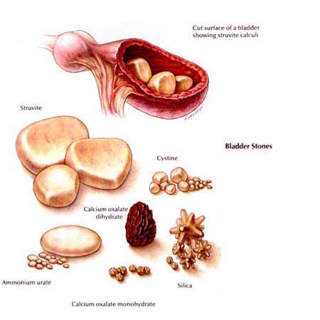 bladder surgery